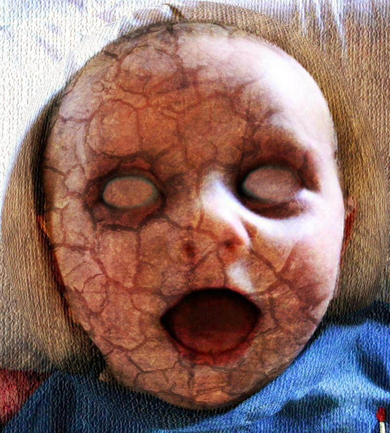 The gallery for --> Harlequin Fetus